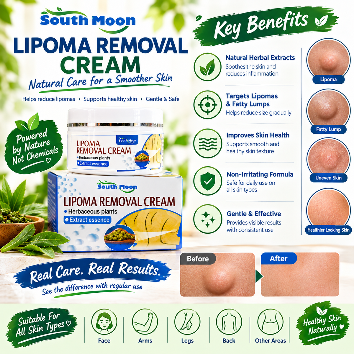 South Moon Lipoma Removal Cream – Herbal Extract Skin Care Cream